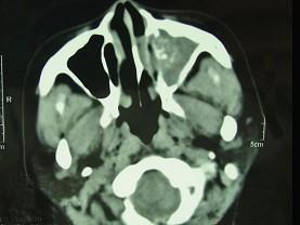 卫生招聘（耳鼻喉科汇总）,章节练习,基础复习,鼻科学
