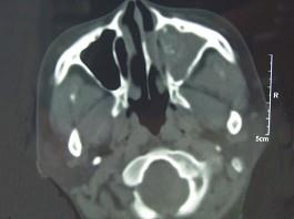 卫生招聘（耳鼻喉科汇总）,章节练习,基础复习,鼻科学