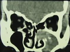 卫生招聘（耳鼻喉科汇总）,章节练习,基础复习,鼻科学