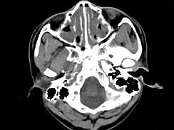 卫生招聘（耳鼻喉科汇总）,章节练习,基础复习,鼻科学