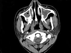 卫生招聘（耳鼻喉科汇总）,章节练习,基础复习,鼻科学