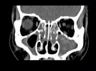 卫生招聘（耳鼻喉科汇总）,章节练习,基础复习,鼻科学