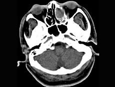 卫生招聘（耳鼻喉科汇总）,章节练习,基础复习,鼻科学