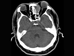 卫生招聘（耳鼻喉科汇总）,章节练习,基础复习,鼻科学