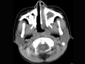 卫生招聘（耳鼻喉科汇总）,章节练习,基础复习,鼻科学