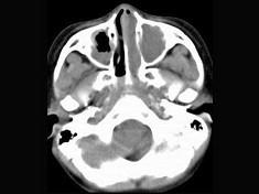 卫生招聘（耳鼻喉科汇总）,章节练习,基础复习,鼻科学