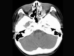 卫生招聘（耳鼻喉科汇总）,章节练习,基础复习,鼻科学