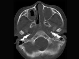 卫生招聘（耳鼻喉科汇总）,章节练习,基础复习,鼻科学