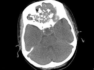 卫生招聘（耳鼻喉科汇总）,章节练习,基础复习,鼻科学