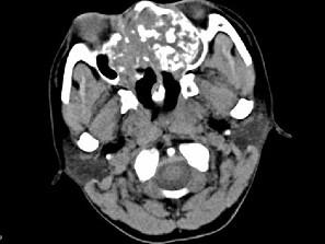 卫生招聘（耳鼻喉科汇总）,章节练习,基础复习,鼻科学