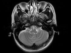 卫生招聘（耳鼻喉科汇总）,章节练习,基础复习,鼻科学