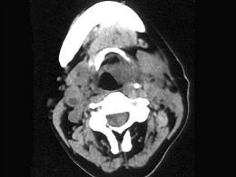 卫生招聘（耳鼻喉科汇总）,章节练习,基础复习,喉科学