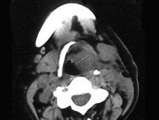 卫生招聘（耳鼻喉科汇总）,章节练习,基础复习,喉科学