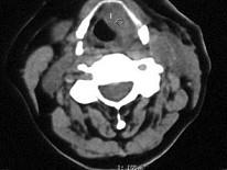 卫生招聘（耳鼻喉科汇总）,章节练习,基础复习,喉科学