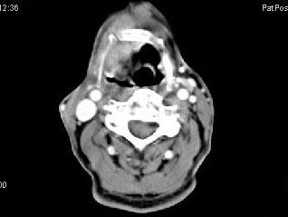 卫生招聘（耳鼻喉科汇总）,章节练习,基础复习,喉科学