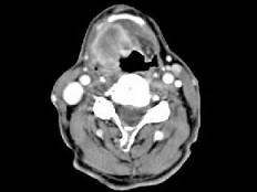 卫生招聘（耳鼻喉科汇总）,章节练习,基础复习,喉科学