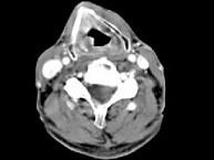 卫生招聘（耳鼻喉科汇总）,章节练习,基础复习,喉科学