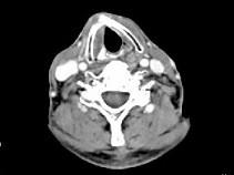 卫生招聘（耳鼻喉科汇总）,章节练习,基础复习,喉科学