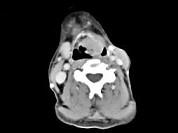 卫生招聘（耳鼻喉科汇总）,章节练习,基础复习,喉科学