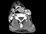 卫生招聘（耳鼻喉科汇总）,章节练习,基础复习,喉科学