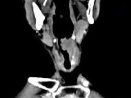 卫生招聘（耳鼻喉科汇总）,章节练习,基础复习,喉科学