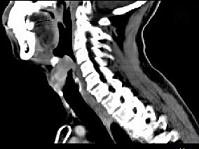 卫生招聘（耳鼻喉科汇总）,章节练习,基础复习,喉科学